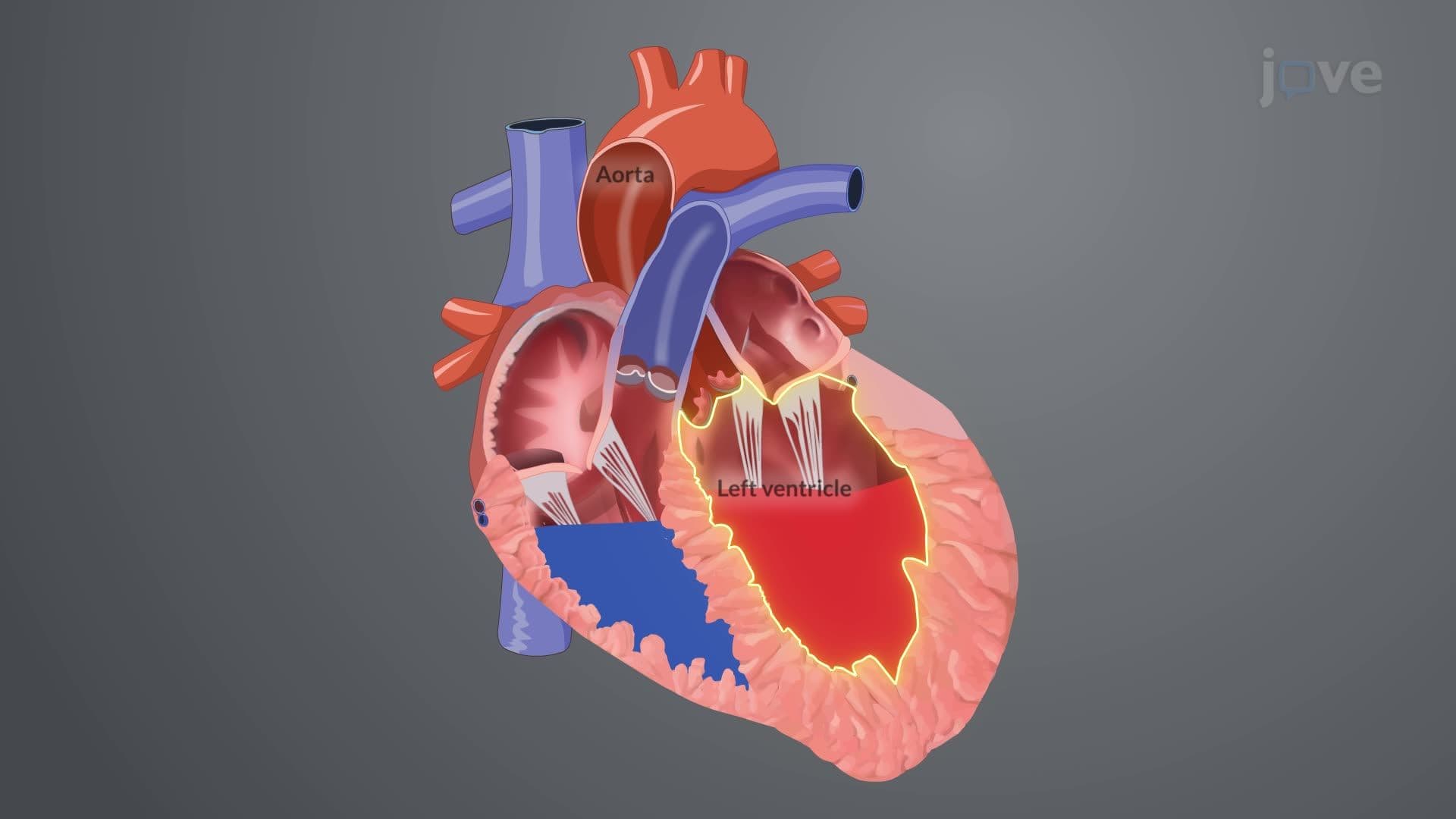 Aortic Regurgitation I: Introduction