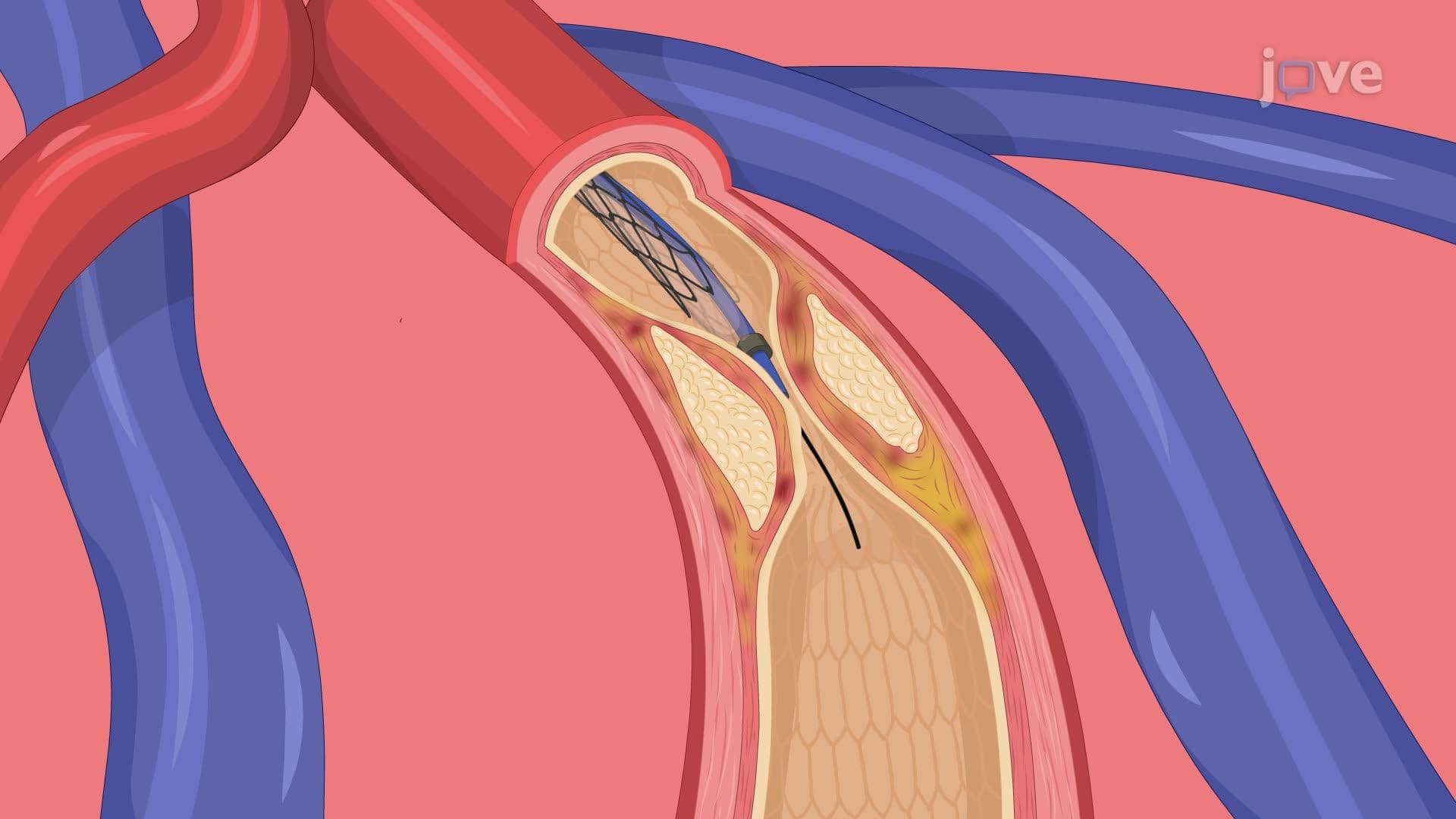 Angina IV: Management