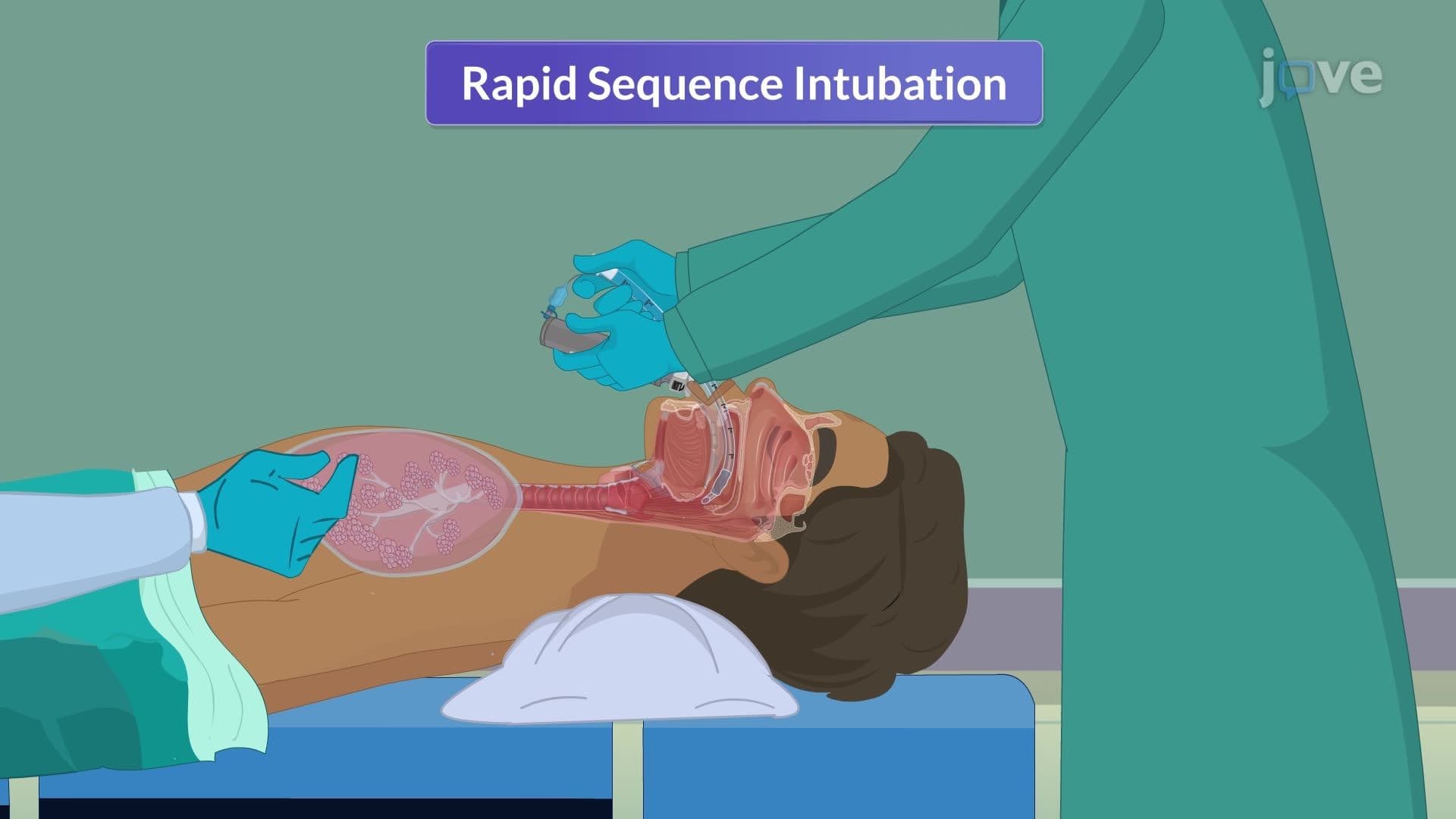 Cardiopulmonary Resuscitation V: Advanced Airway Management Techniques