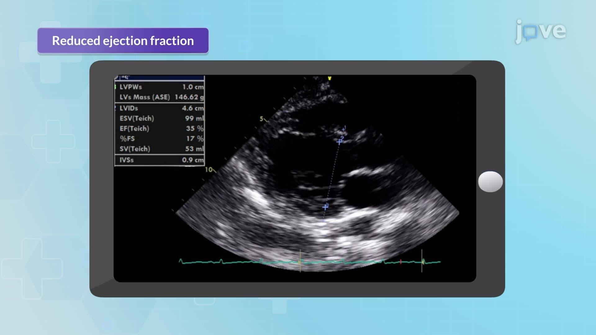 Heart Failure VII: Nursing Interventions