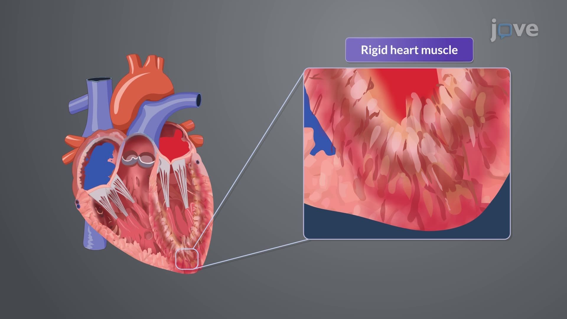 Cardiomyopathy I: Introduction and Classification