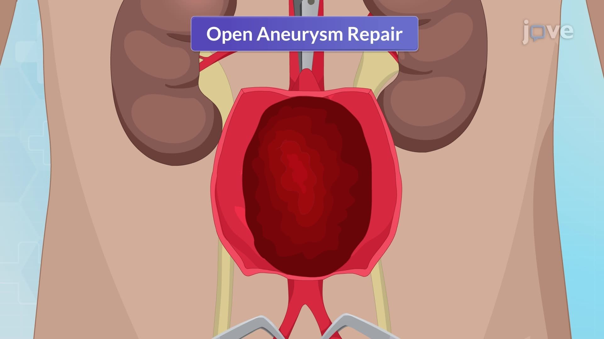 Aneurysm III: Interprofessional Care