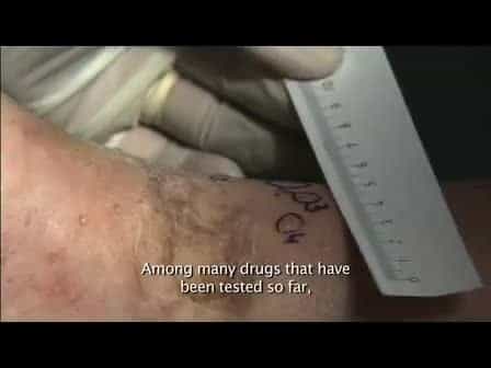 Electrochemotherapy of Tumours