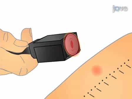 Determining heat and mechanical pain threshold in inflamed skin of human subjects