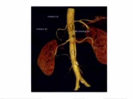 Laparoscopic Left Liver Sectoriectomy of Caroli's Disease Limited to Segment II and III