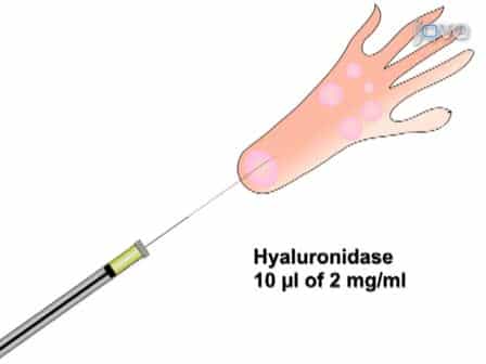 DNA Transfection of Mammalian Skeletal Muscles using In Vivo Electroporation
