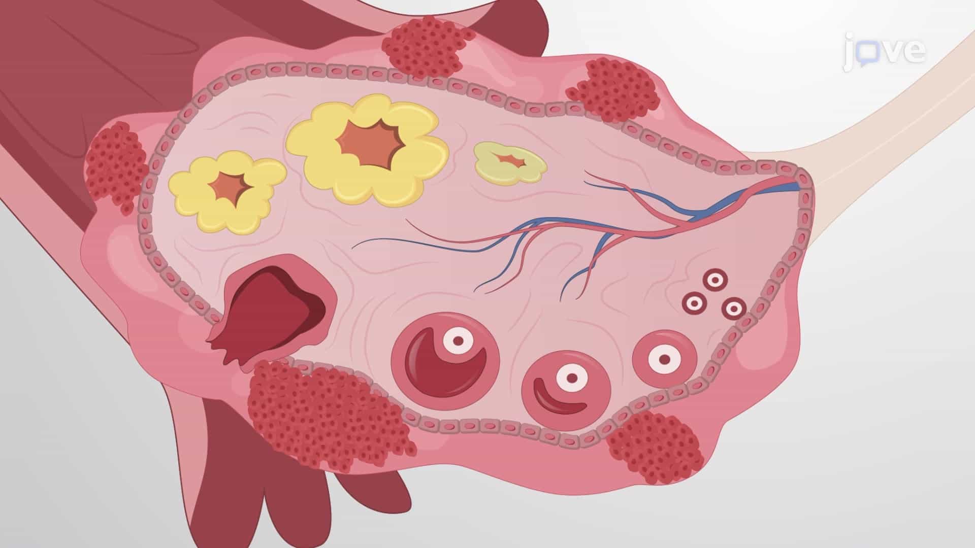 Obtaining Primary Ovarian Cancer Cells from Solid Specimens: A Method to Culture Epithelial Ovarian Cancer Cells from Ovarian Tumor Specimens