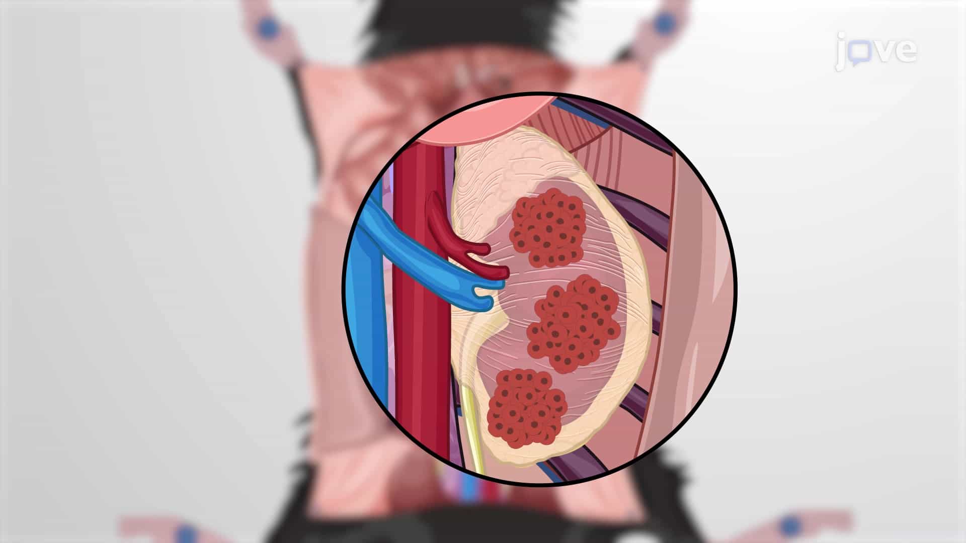 Generating Renal Cell Carcinoma Model: A Protocol to Develop Orthotopic RCC Murine Model by Intrarenal Implantation of Cancer Cells