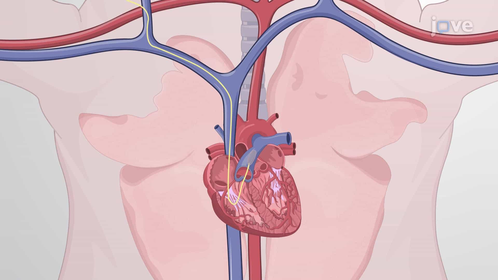 Seldinger Technique Based Pulmonary Artery Catheterization: A Procedure to Insert Pulmonary Artery Catheter Through the Jugular Vein in a Porcine Model