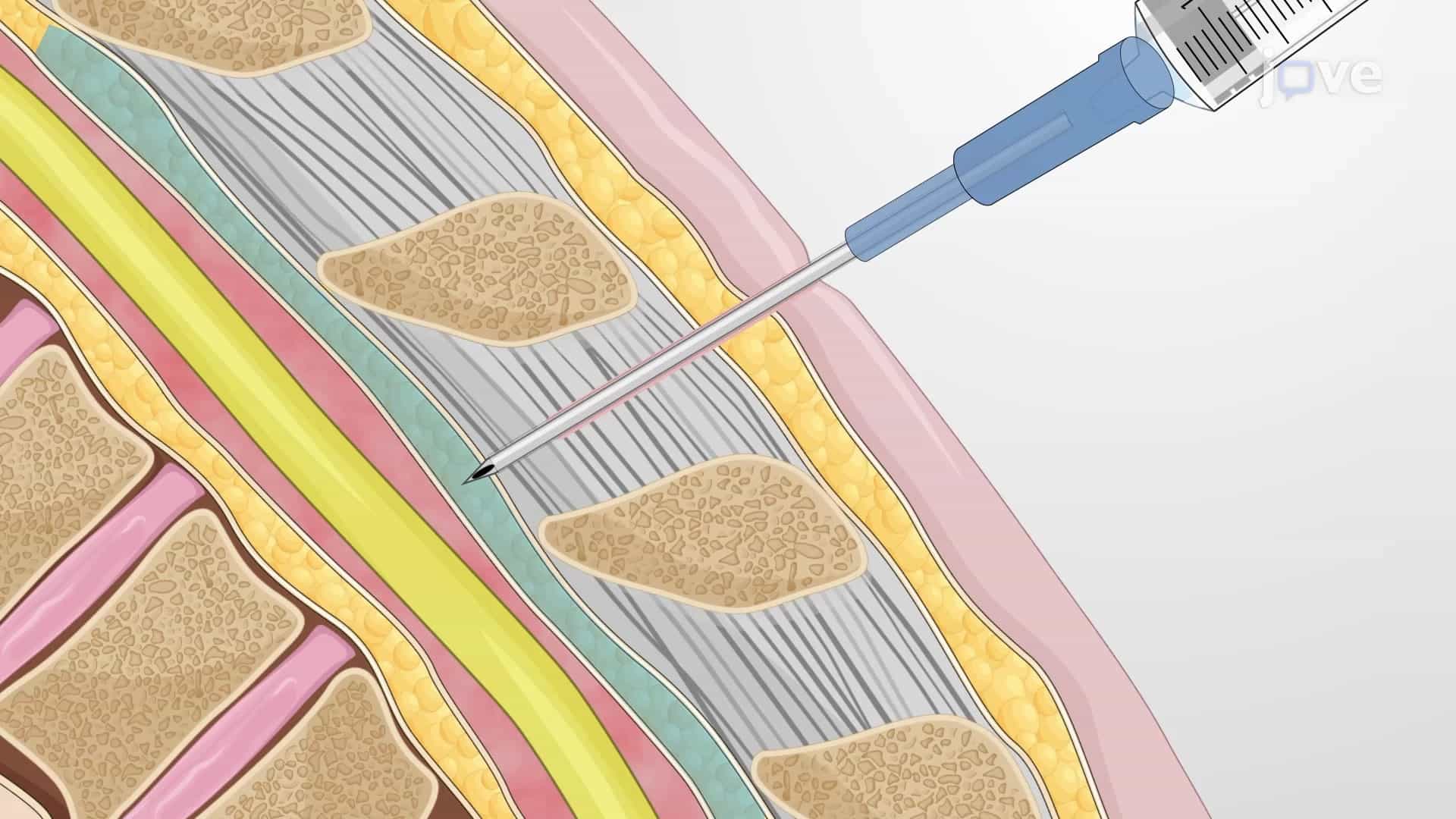Intrathecal Placement of Lumbar Drain: A Technique to Withdraw Cerebrospinal Fluid from the Lumbar Spine in Porcine Model