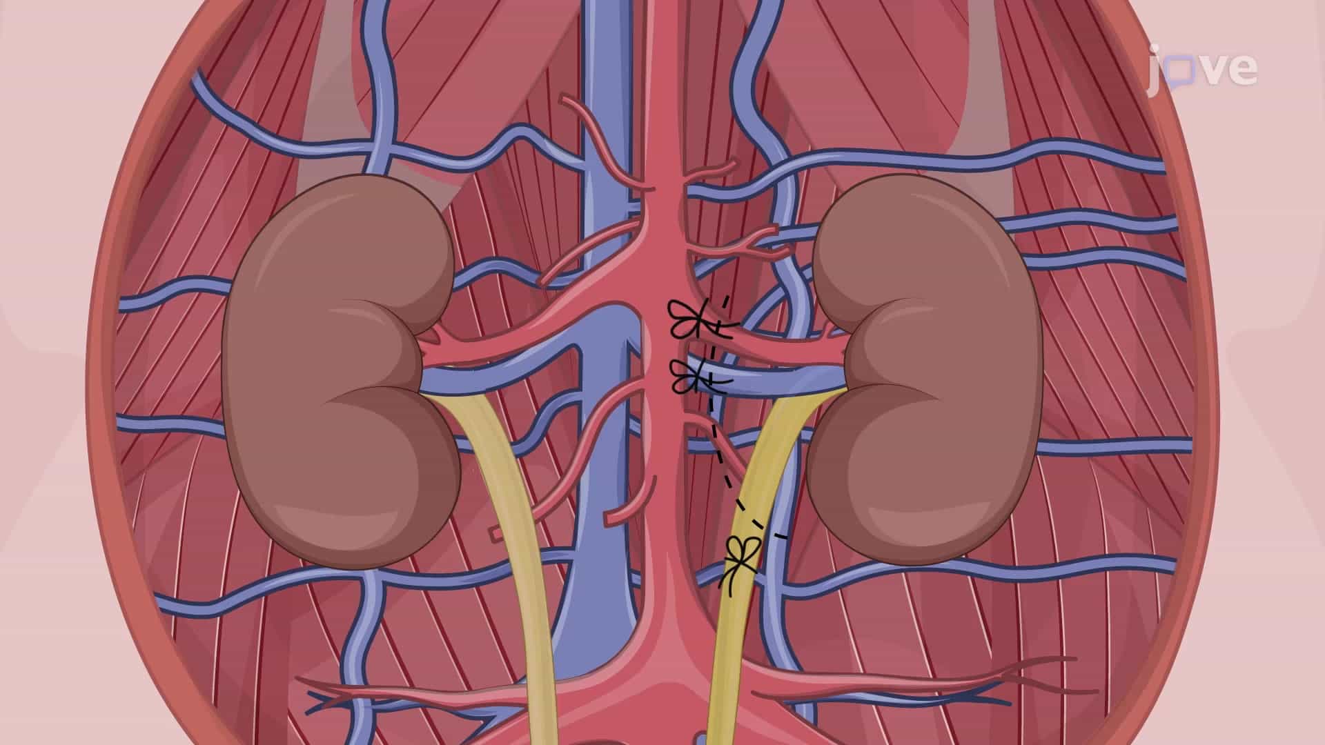 Nephrectomy in a Porcine Model: A Surgical Procedure to Retrieve Porcine Kidney Graft for Transplantation