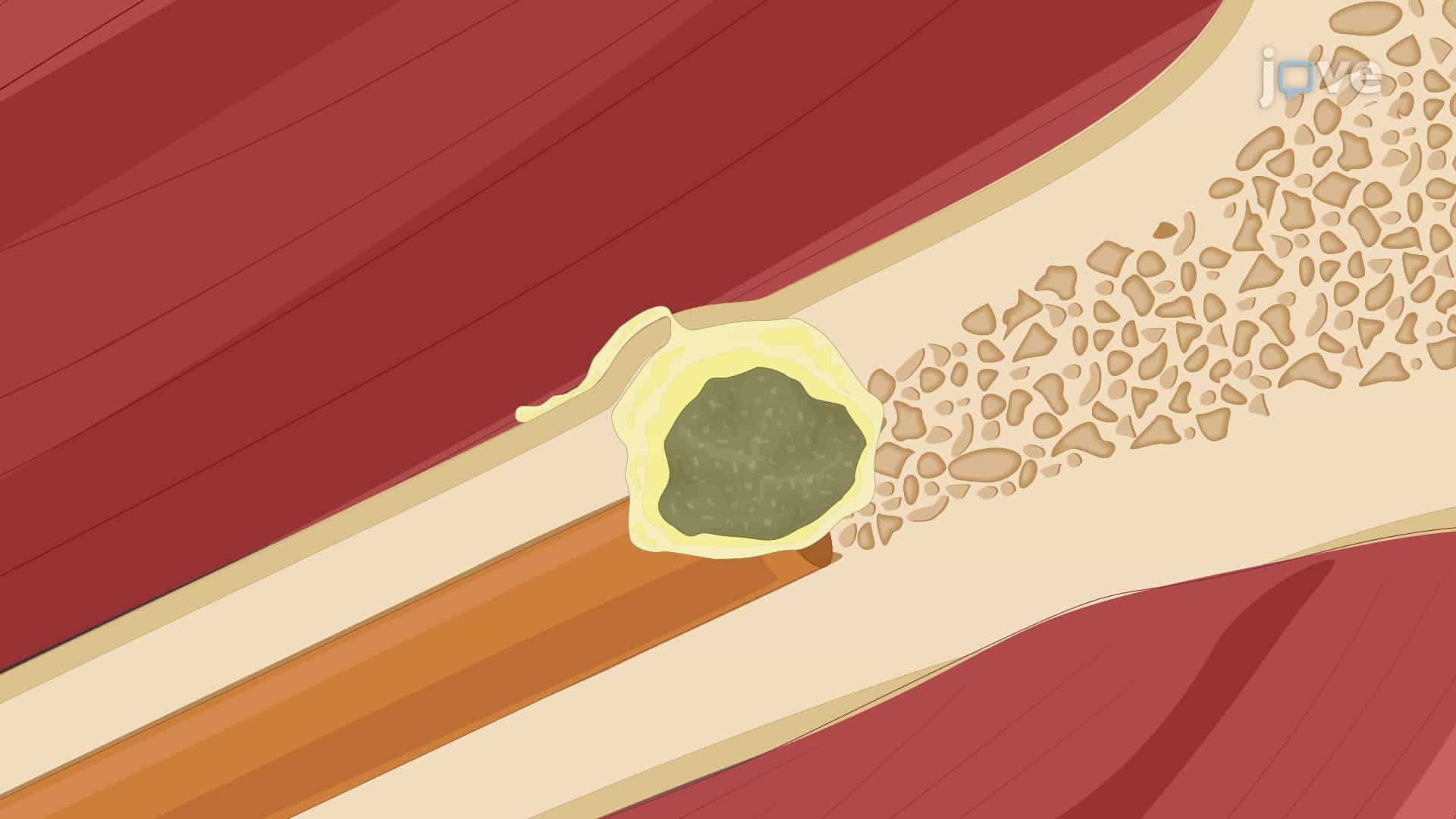Generating Rabbit Model of Bone Infection: A Technique of Inducing Chronic Infection by Injecting Bacteria Directly in Bone Marrow