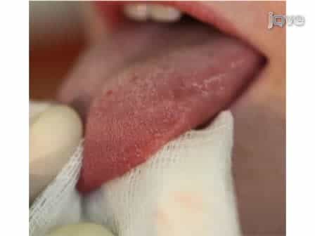 Technique to Collect Fungiform (Taste) Papillae from Human Tongue