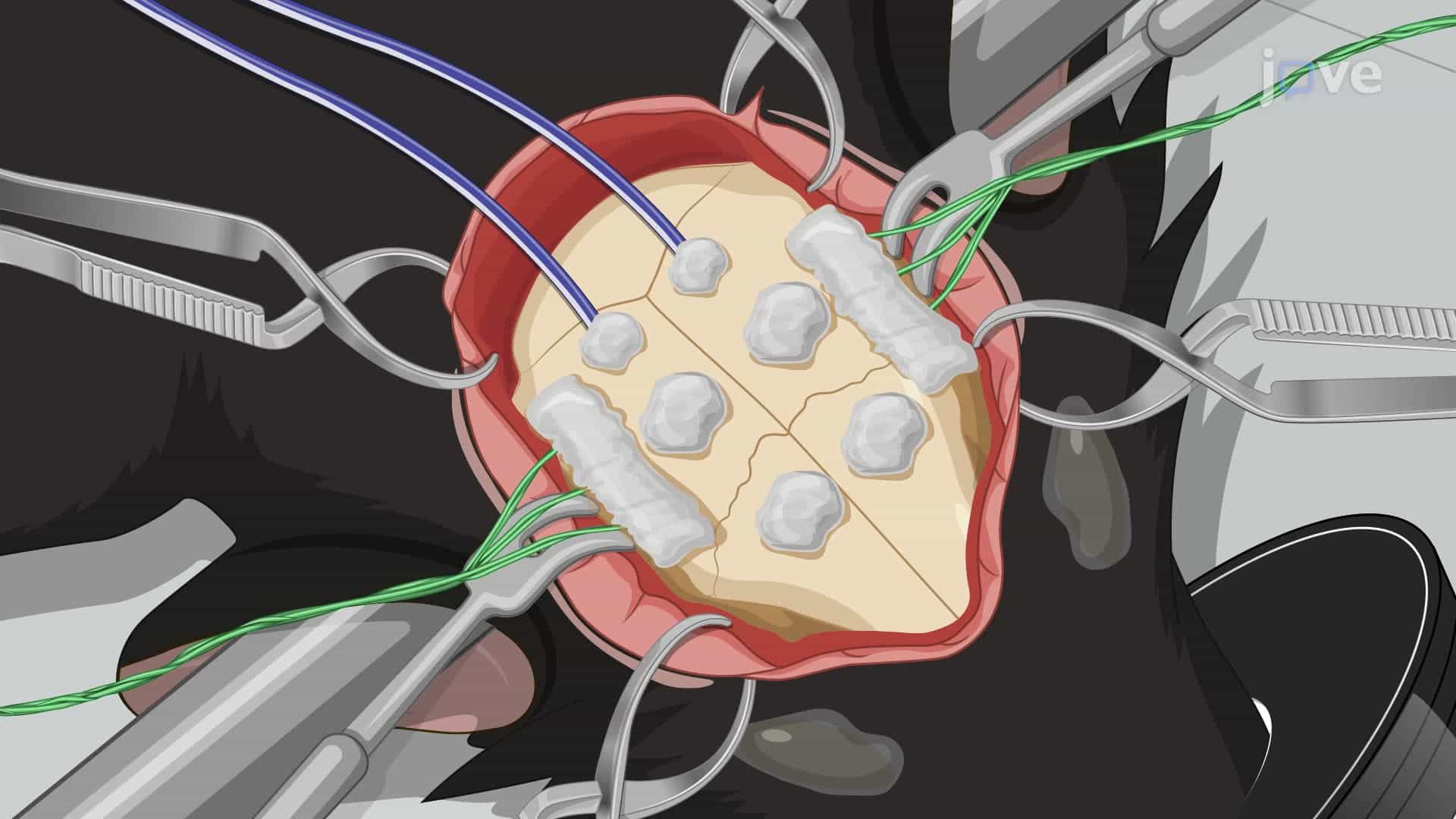 Implanting an On-Head Electrode System in a Rat Model for Real-Time Seizure Detection