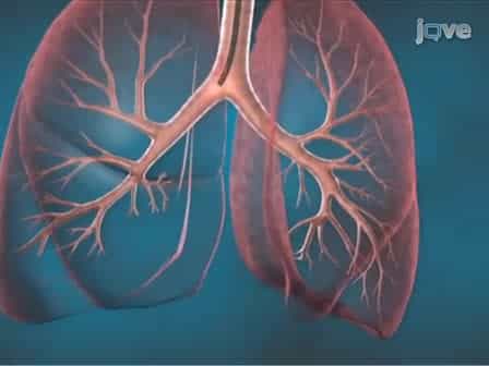 Bronchial Thermoplasty: A Novel Therapeutic Approach to Severe Asthma