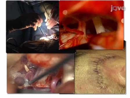 Microvascular Decompression: Salient Surgical Principles and Technical Nuances