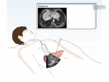 Thermal Ablation for the Treatment of Abdominal Tumors
