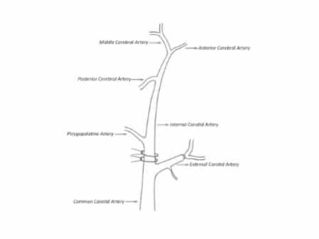 Intraluminal Middle Cerebral Artery Occlusion MCAO Model for Ischemic Stroke with Laser Doppler Flowmetry Guidance in Mice