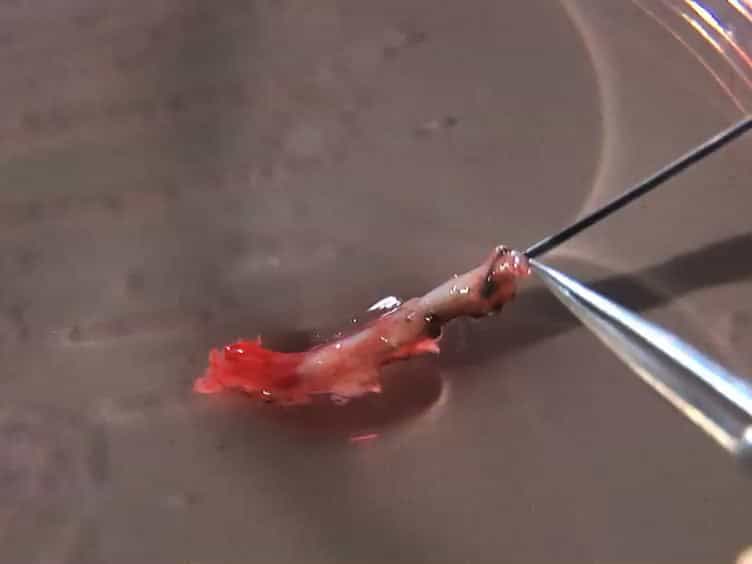 Human Internal Mammary Artery IMA Transplantation and Stenting: A Human Model to Study the Development of In-Stent Restenosis