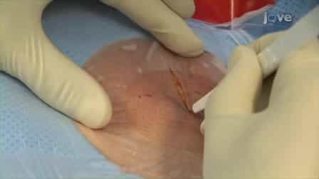 A New Single Chamber Implantable Defibrillator with Atrial Sensing: A Practical Demonstration of Sensing and Ease of Implantation