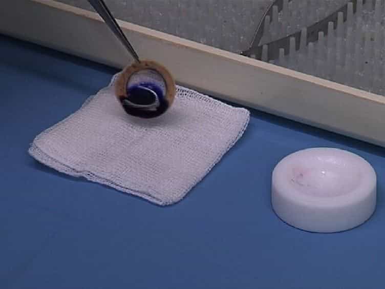 A Simplified Technique for In situ Excision of Cornea and Evisceration of Retinal Tissue from Human Ocular Globe