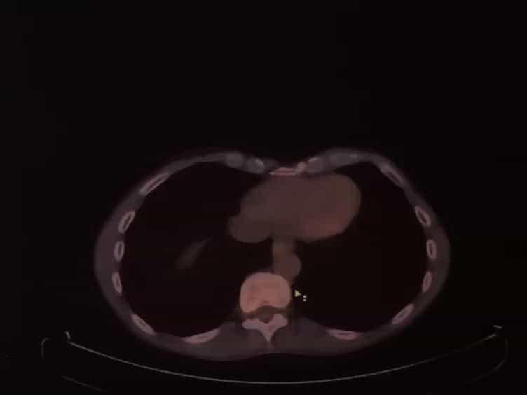 Quantification of Atherosclerotic Plaque Activity and Vascular Inflammation using [18-F] Fluorodeoxyglucose Positron Emission Tomography/Computed Tomography FDG-PET/CT