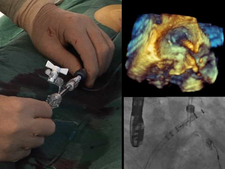 Catheter Ablation in Combination With Left Atrial Appendage Closure for Atrial Fibrillation