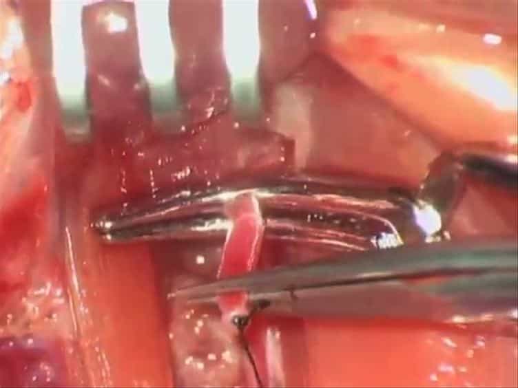 Training a Sophisticated Microsurgical Technique: Interposition of External Jugular Vein Graft in the Common Carotid Artery in Rats