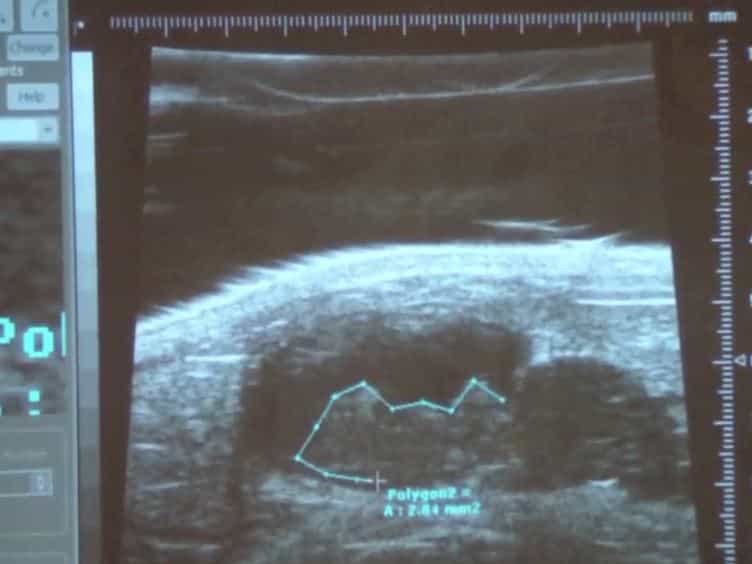 An Orthotopic Bladder Tumor Model and the Evaluation of Intravesical saRNA Treatment
