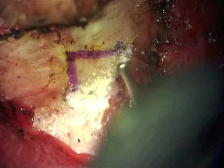 Utilizing a Cranial Window to Visualize the Middle Cerebral Artery During Endothelin-1 Induced Middle Cerebral Artery Occlusion