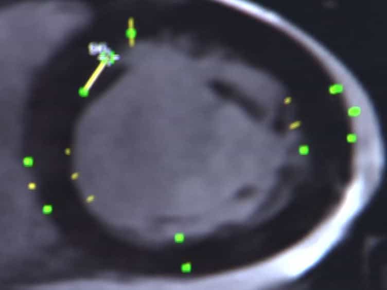 Reduction in Left Ventricular Wall Stress and Improvement in Function in Failing Hearts using Algisyl-LVR