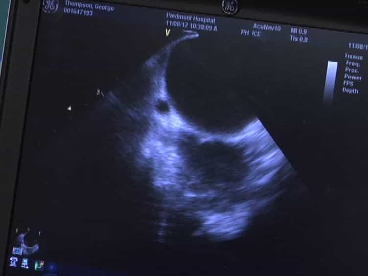 Direct Pressure Monitoring Accurately Predicts Pulmonary Vein Occlusion During Cryoballoon Ablation