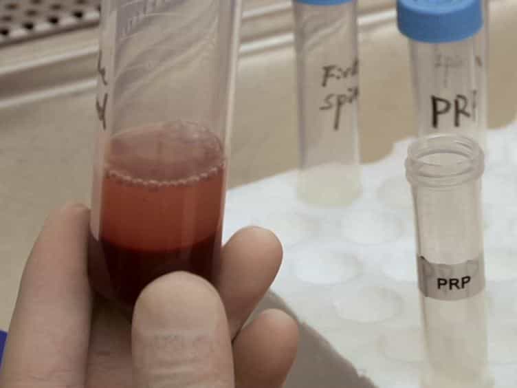 PRP as a New Approach to Prevent Infection: Preparation and In vitro Antimicrobial Properties of PRP