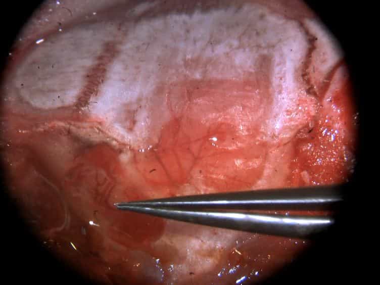 Permanent Cerebral Vessel Occlusion via Double Ligature and Transection
