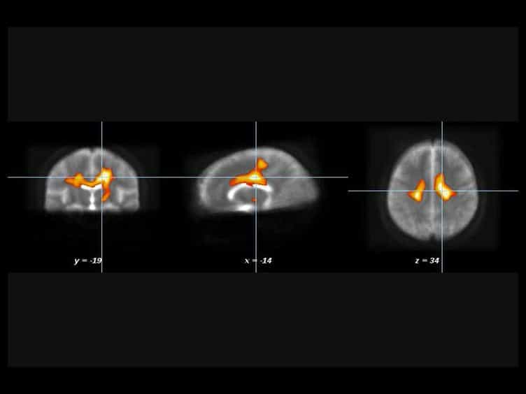 Diffusion Tensor Magnetic Resonance Imaging in the Analysis of Neurodegenerative Diseases
