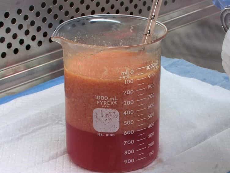 Manual Isolation of Adipose-derived Stem Cells from Human Lipoaspirates
