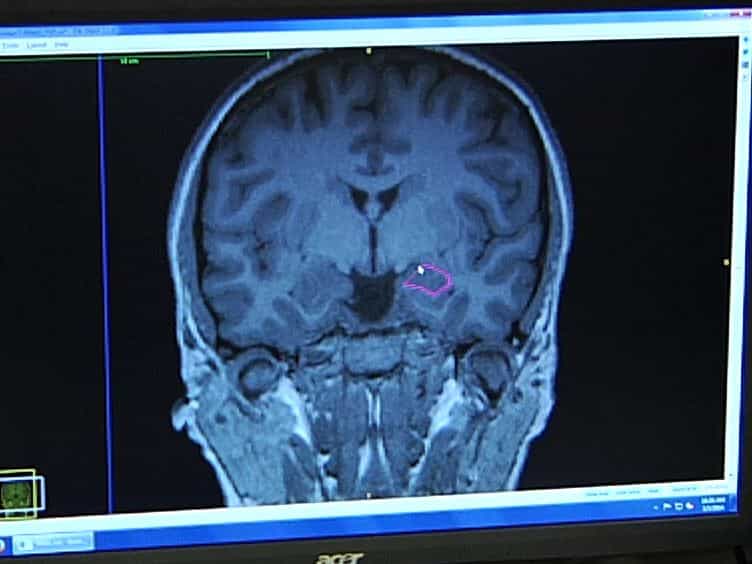 A Comprehensive Protocol for Manual Segmentation of the Medial Temporal Lobe Structures