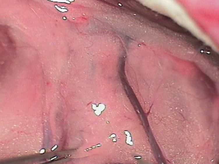 The Helsinki Rat Microsurgical Sidewall Aneurysm Model