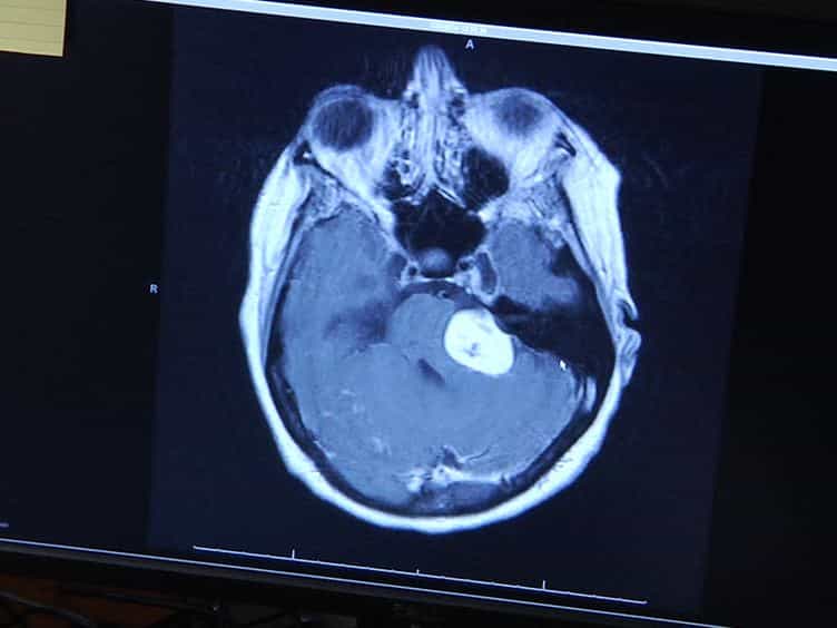 Primary Culture of Human Vestibular Schwannomas