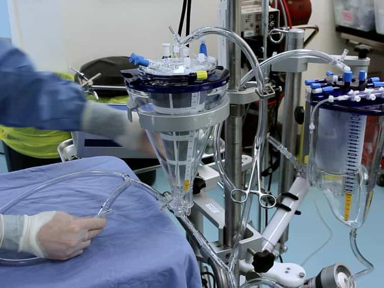 Technique of Subnormothermic Ex Vivo Liver Perfusion for the Storage, Assessment, and Repair of Marginal Liver Grafts