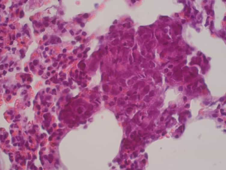 Orthotopic Injection of Breast Cancer Cells into the Mammary Fat Pad of Mice to Study Tumor Growth.