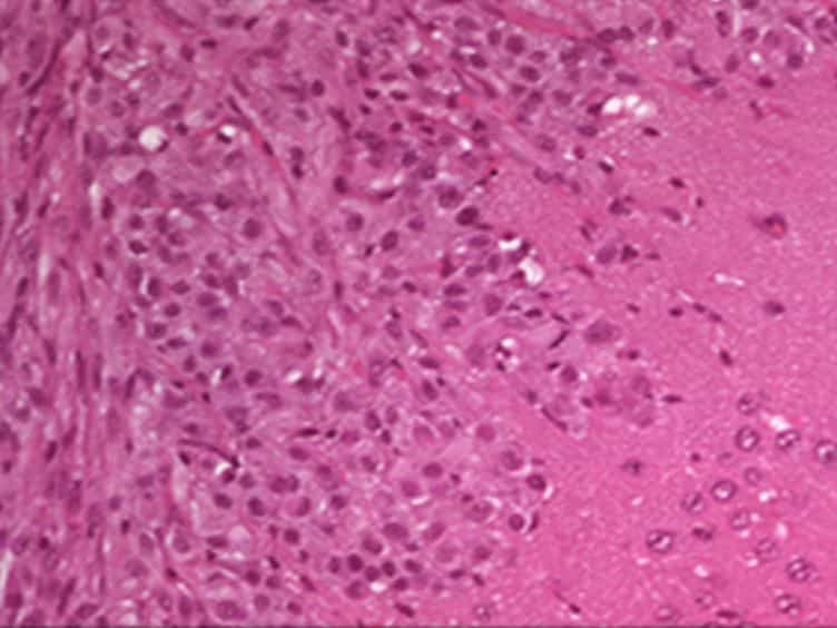 Creating Anatomically Accurate and Reproducible Intracranial Xenografts of Human Brain Tumors
