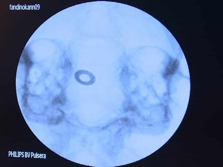 The Rabbit Blood-shunt Model for the Study of Acute and Late Sequelae of Subarachnoid Hemorrhage: Technical Aspects