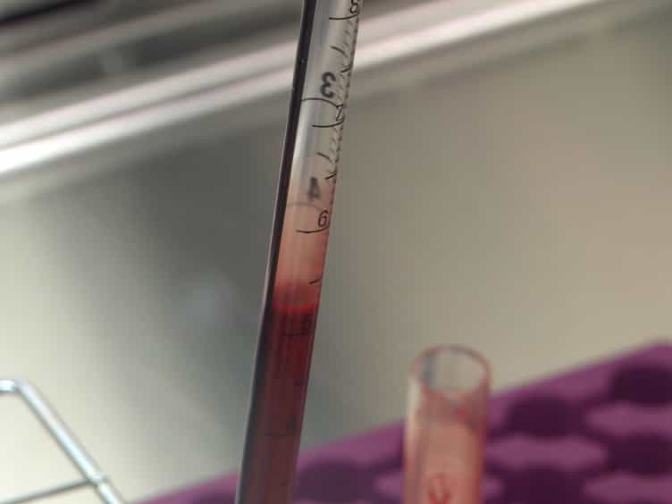 Detecting Glycogen in Peripheral Blood Mononuclear Cells with Periodic Acid Schiff Staining