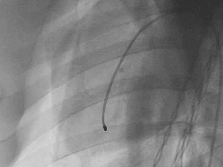 An Injectable and Drug-loaded Supramolecular Hydrogel for Local Catheter Injection into the Pig Heart