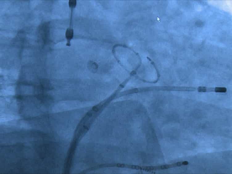 Robotic Ablation of Atrial Fibrillation
