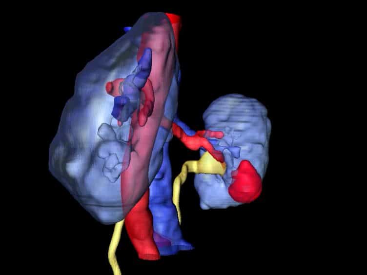 In Vivo, Percutaneous, Needle Based, Optical Coherence Tomography of Renal Masses