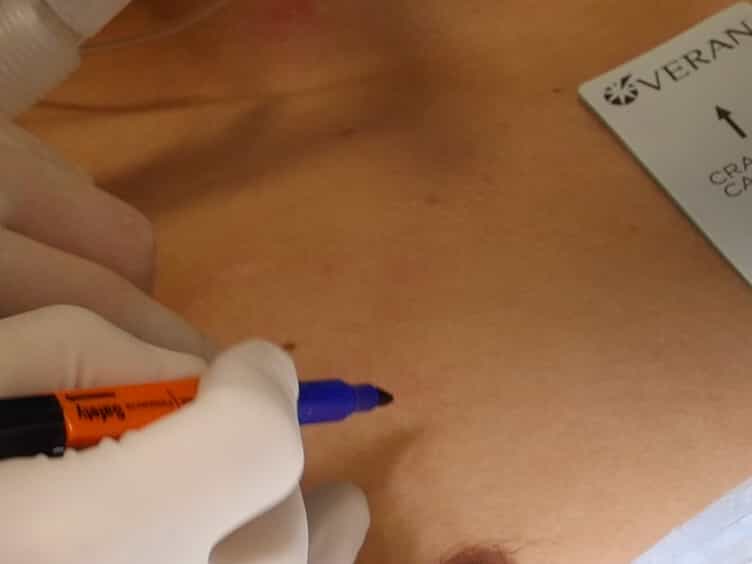 Use of Electromagnetic Navigational Transthoracic Needle Aspiration E-TTNA for Sampling of Lung Nodules