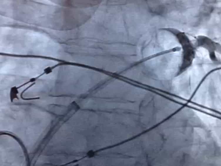 Reduction of Iatrogenic Atrial Septal Defects with an Anterior and Inferior Transseptal Puncture Site when Operating the Cryoballoon Ablation Catheter