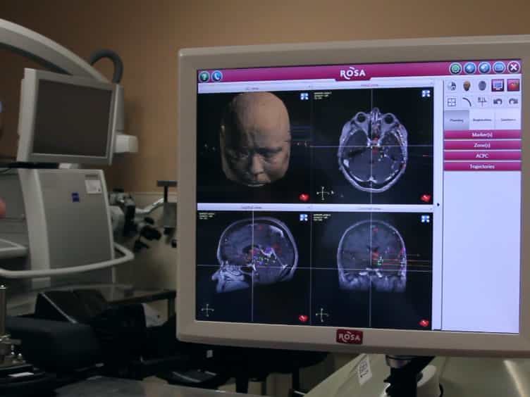 Stereo-Electro-Encephalo-Graphy SEEG With Robotic Assistance in the Presurgical Evaluation of Medical Refractory Epilepsy: A Technical Note
